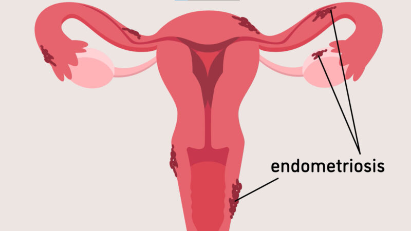 Endometriosis